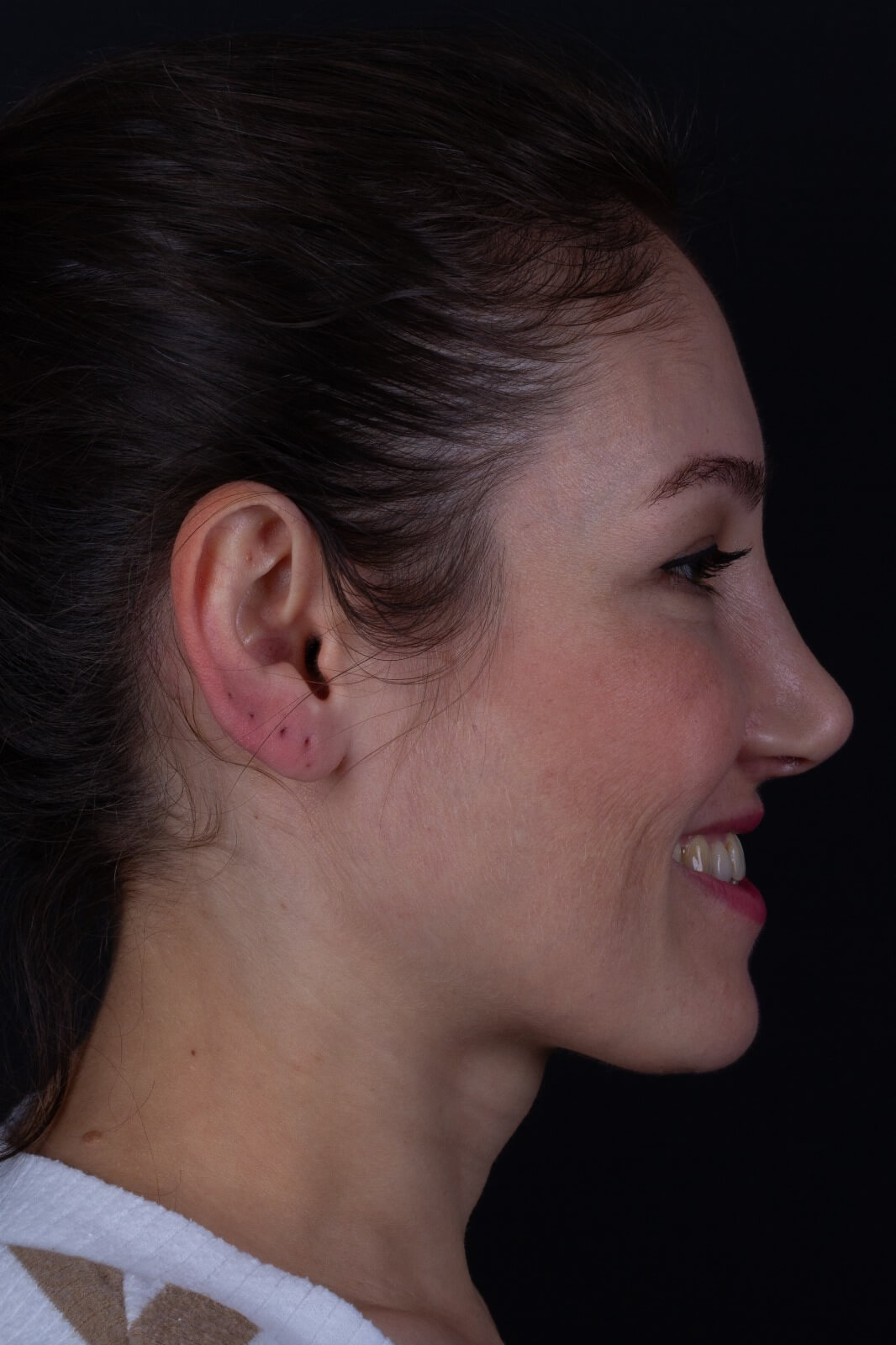 Sağ profil: Dişler okluzyonda gülerken